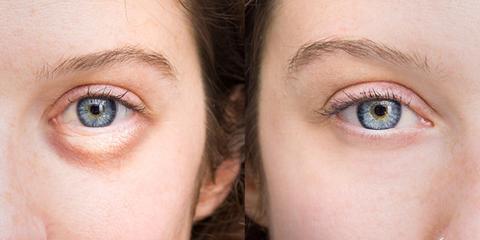 what causes puffy eyes