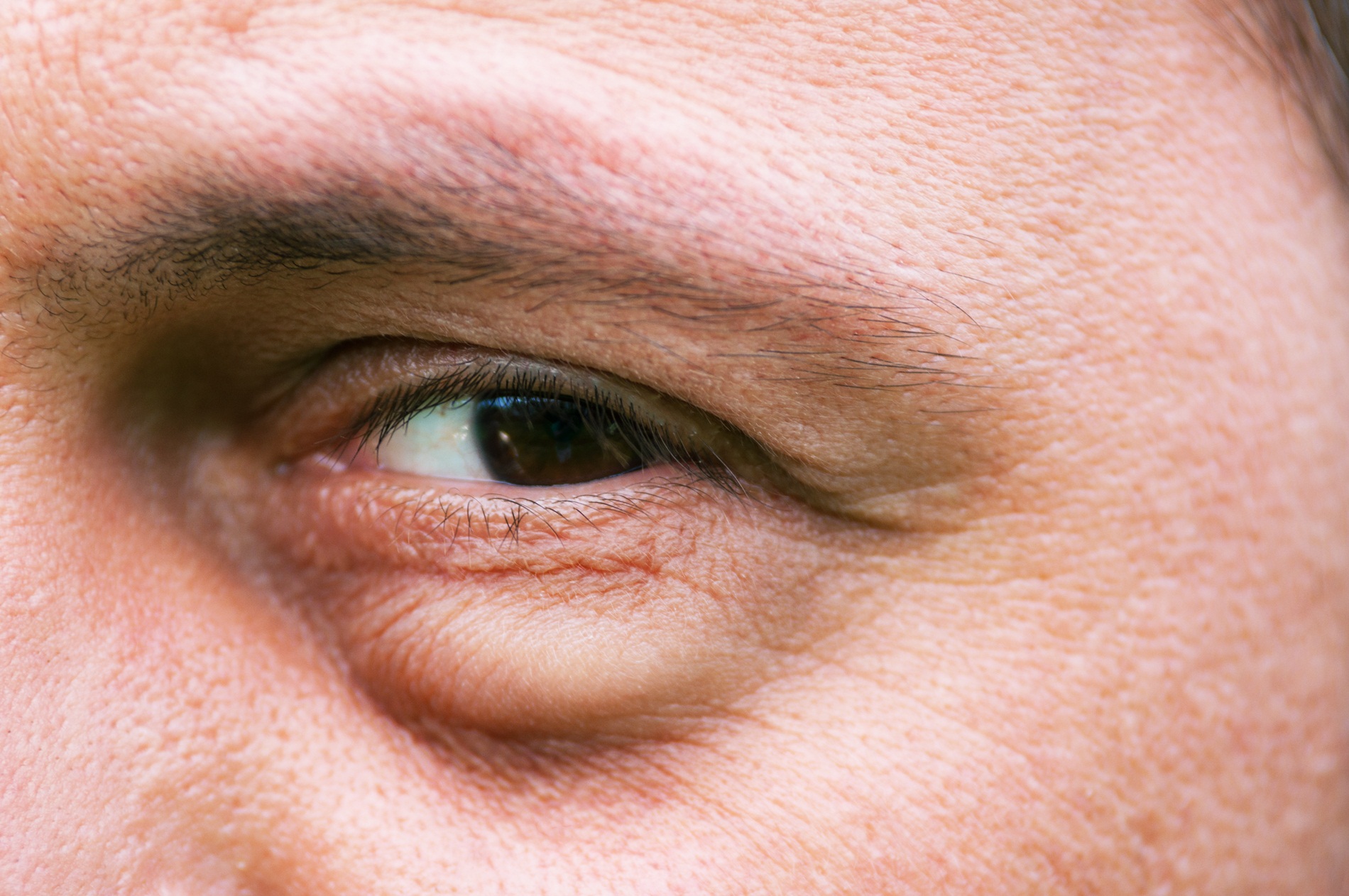 Лечение мешков под глазами у мужчин. Блефарохалазис верхних век что это.