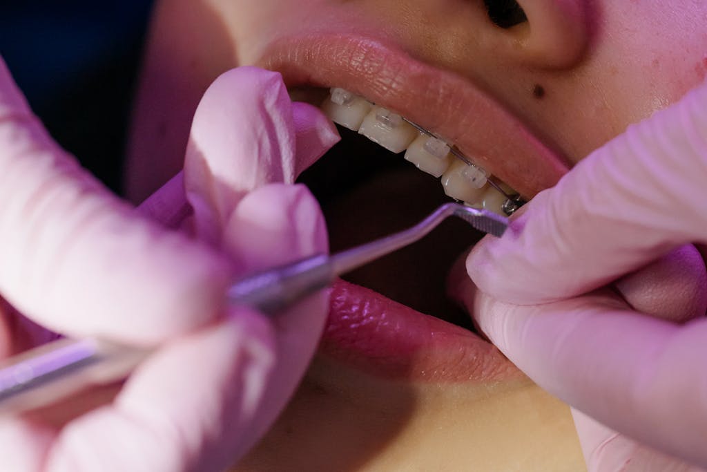 Treating of a Teeth with Braces